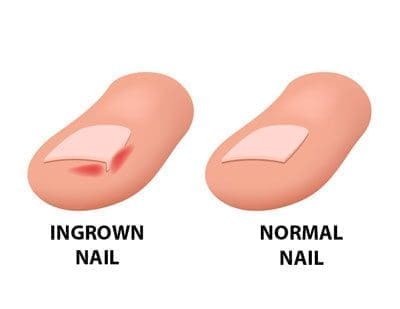 Ingrown Nails: Causes, Prevention, and Treatment | Avita Health System Ingrown Nails: Causes, Prevention, and Treatment | Avita Health System
