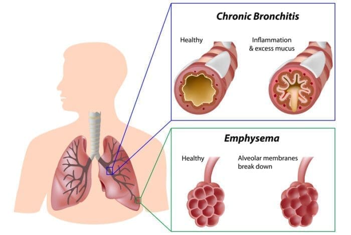 Chronic Obstructive Pulmonary Disease (COPD) | Avita Health System